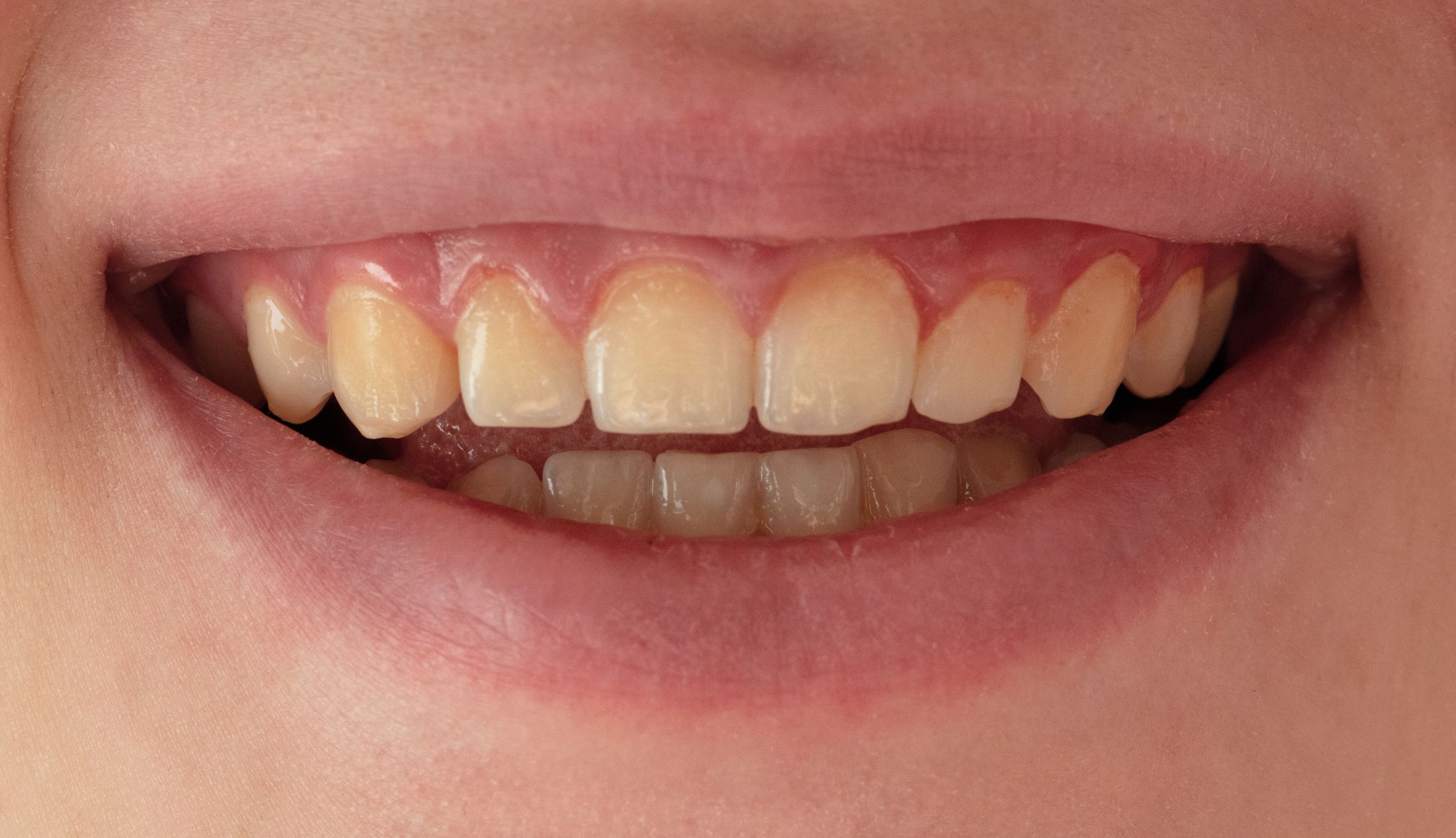 Read more about the article Why Are My Teeth Yellow When I Brush Them Every Day?